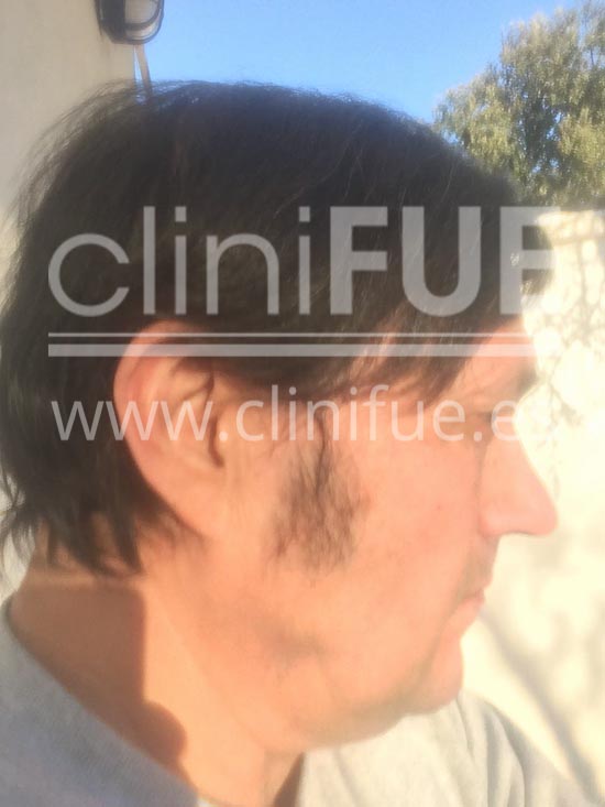 Carlos 56 Madrid trasplante capilar turquia 12 meses