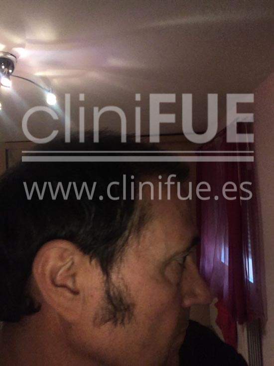 Carlos 56 Madrid trasplante capilar turquia 4 meses