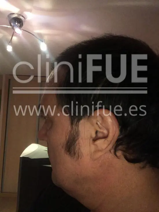 Carlos 56 Madrid trasplante capilar turquia 4 meses