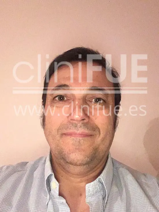 Carlos 56 Madrid trasplante capilar turquia 6 meses