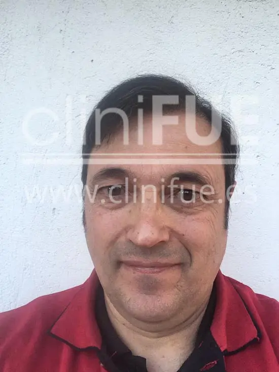 Carlos 56 Madrid trasplante capilar turquia 9 meses