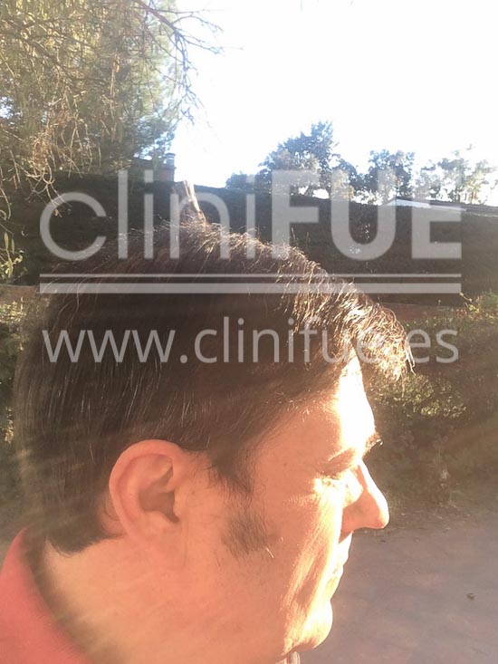 Carlos 56 Madrid trasplante capilar turquia 9 meses