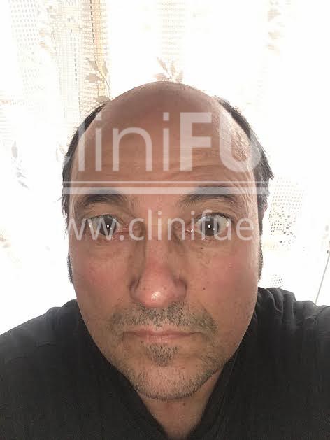 Carlos 56 Madrid trasplante capilar turquia Antes