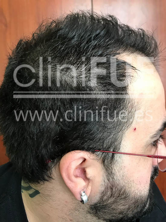 Fernando 33 Palencia injerto capilar turquia 6 meses