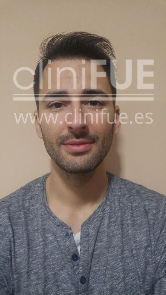 Guillermo 26 Murcia trasplante capilar turquia 6 meses