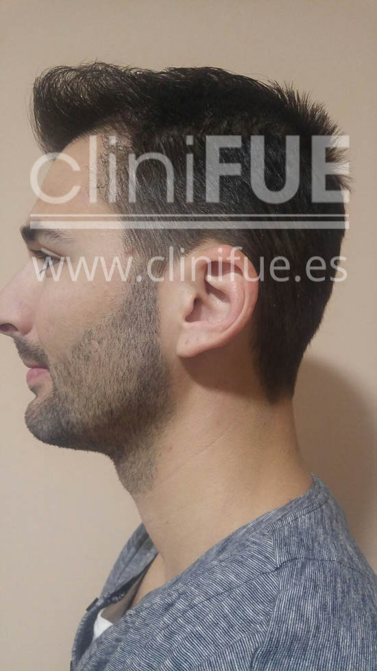 Guillermo 26 Murcia trasplante capilar turquia 6 meses