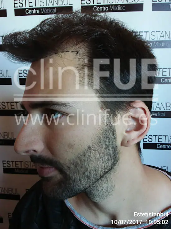 Guillermo 26 Murcia trasplante capilar turquia Antes