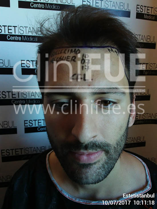 Guillermo 26 años Murcia trasplante capilar turquia Dia Operacion