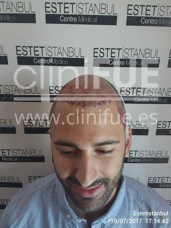 Guillermo 26 años Murcia trasplante capilar turquia Dia Operacion