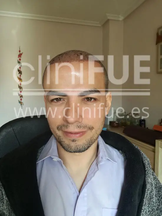 Javier 33 años Elche trasplante capilar turquia 3 días