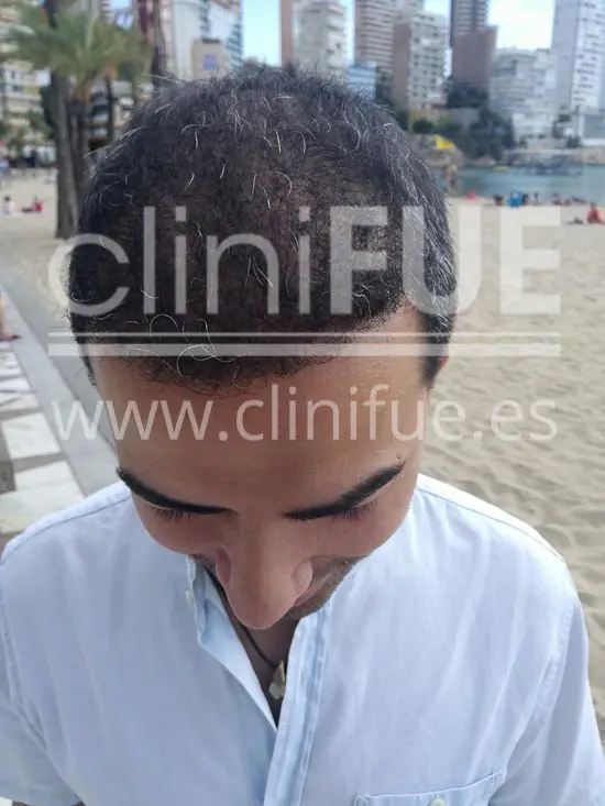 Javier 33 años Elche trasplante capilar turquia 9 meses