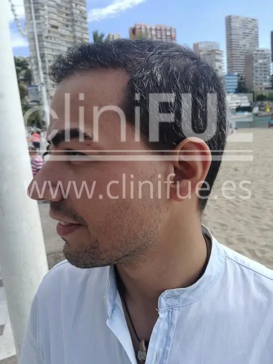 Javier 33 años Elche trasplante capilar turquia 9 meses