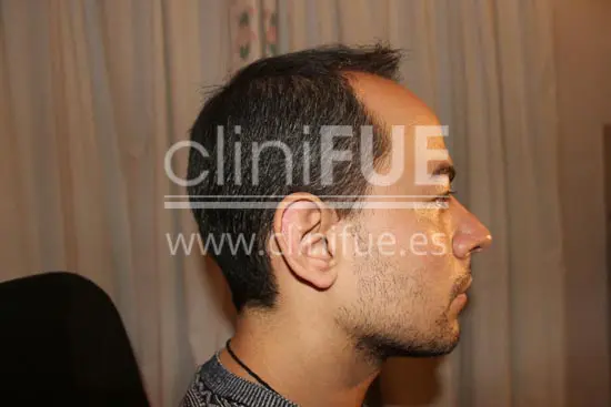 Javier 33 años Elche trasplante capilar turquia Antes