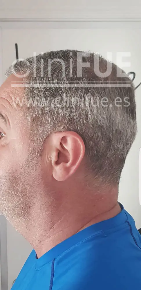 Jorge 49 años Madrid injerto capilar turquia 6 meses