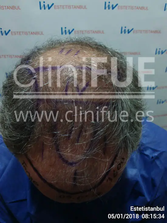 Jorge 49 años Madrid injerto capilar turquia Dia Operacion