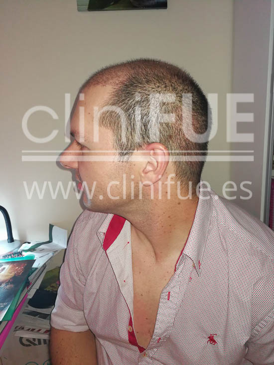 Jose 30 Granada trasplante capilar turquia 15 días
