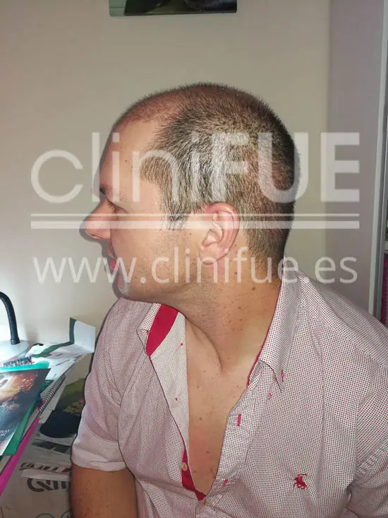 Jose 30 Granada trasplante capilar turquia 15 días