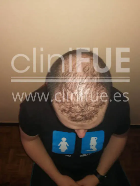 Jose 30 Granada trasplante capilar turquia 6 meses