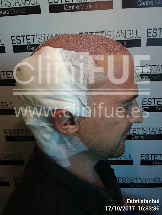 Jose Luis 42 Barcelona injerto pelo turquia dia operacion