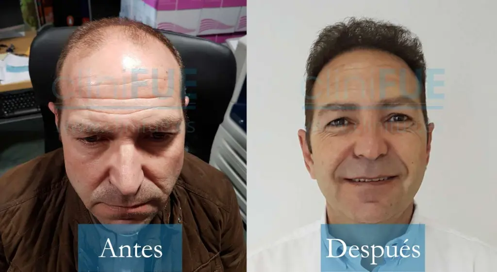 José María 49 años Cáceres 4000UF injerto capilar