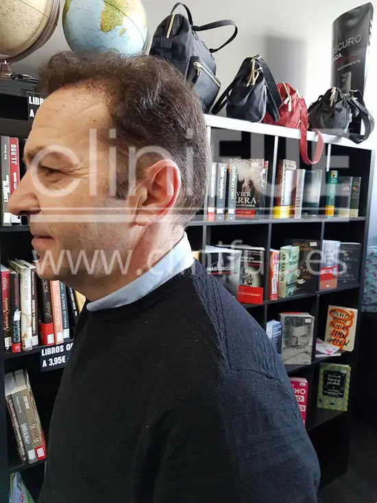 Jose Maria 49 años Caceres injerto de pelo turquia 10 meses