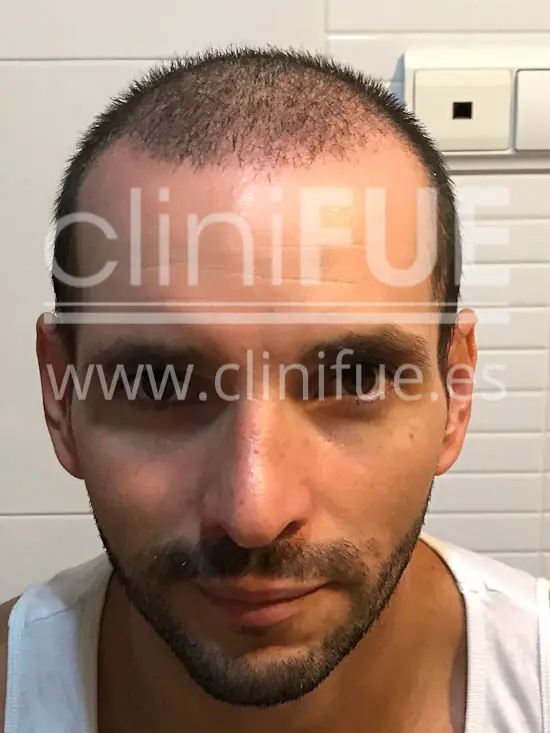 Jose Iñaki 34 Alicante trasplante de pelo turquia 1 mes