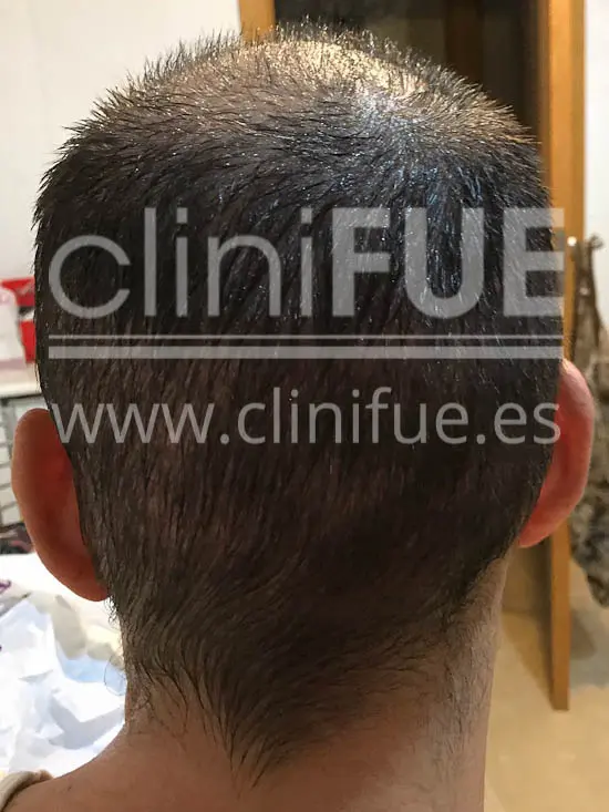 Jose Iñaki 34 Alicante trasplante de pelo turquia 1 mes