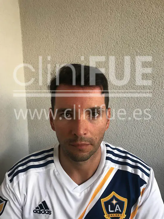 Jose Iñaki 34 Alicante trasplante de pelo turquia 12 meses