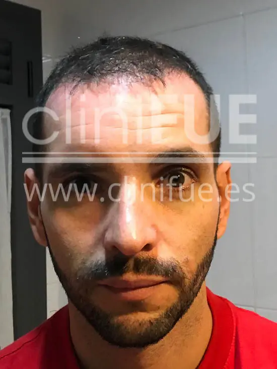 Jose Iñaki 34 Alicante trasplante de pelo turquia 3 meses