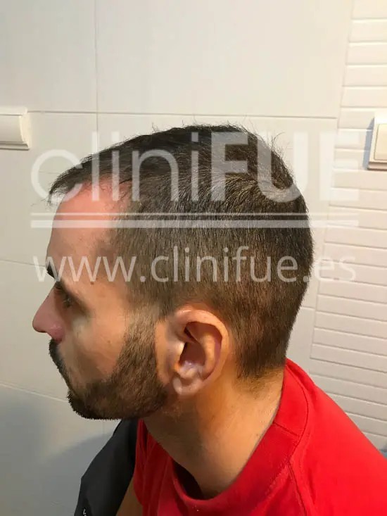 Jose Iñaki 34 Alicante trasplante de pelo turquia 3 meses