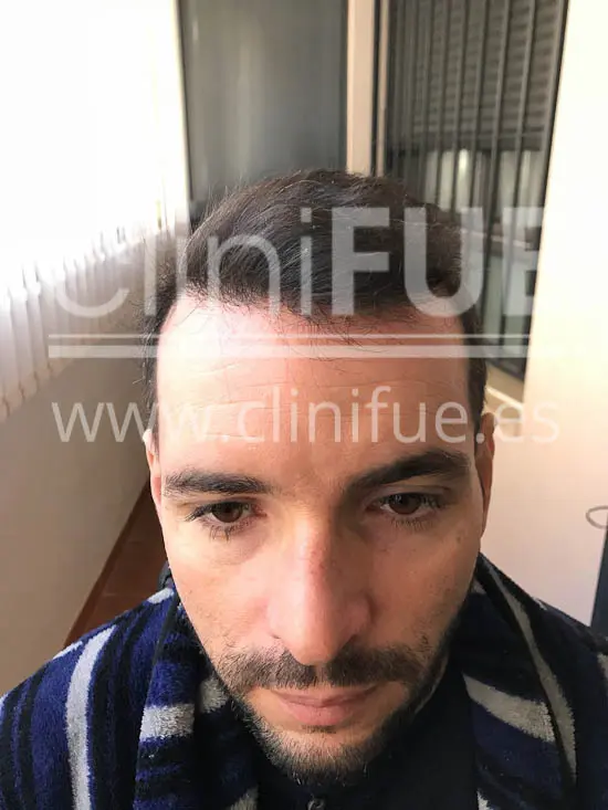 Jose Iñaki 34 Alicante trasplante de pelo turquia 6 meses