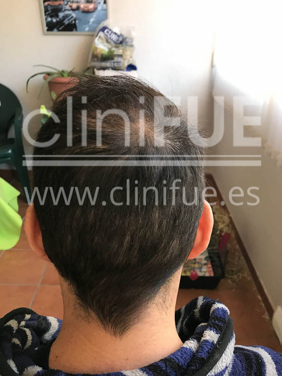 Jose Iñaki 34 Alicante trasplante de pelo turquia 6 meses