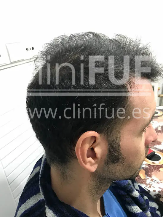 Jose Iñaki 34 Alicante trasplante de pelo turquia 9 meses