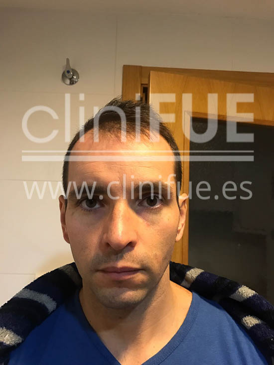 Jose Iñaki 34 Alicante trasplante de pelo turquia Antes