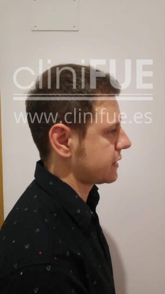 Rudy 37 Teruel trasplante capilar turquia 12 meses