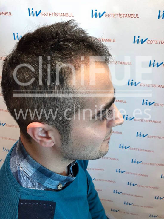 Sinan 29 Estambul trasplante capilar turquia 3 meses