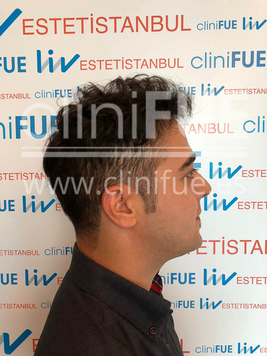 Sinan 29 Estambul trasplante capilar turquia 9 meses
