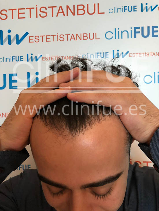 Sinan 29 Estambul trasplante capilar turquia 9 meses