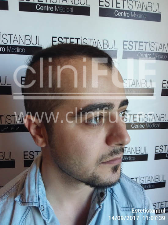 Sinan 29 Estambul trasplante capilar turquia Antes