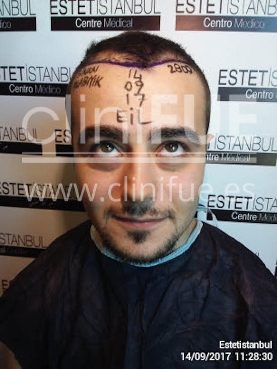 Sinan 29 Estambul trasplante capilar turquia diseño
