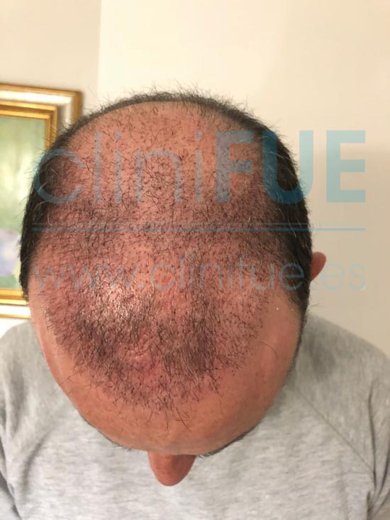 Antonio 39 años Murcia trasplante capilar turquia 1 mes