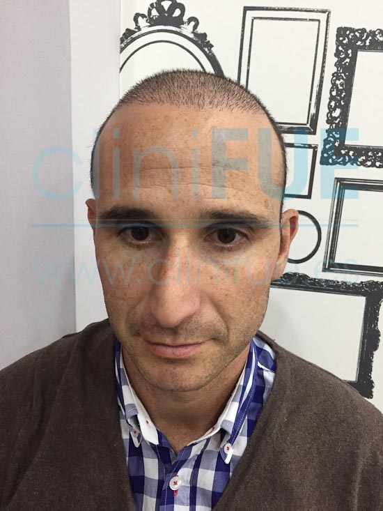 Antonio 39 años Murcia trasplante capilar turquia 15 dias