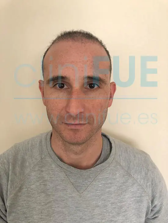 Antonio 39 años Murcia trasplante capilar turquia 2 meses