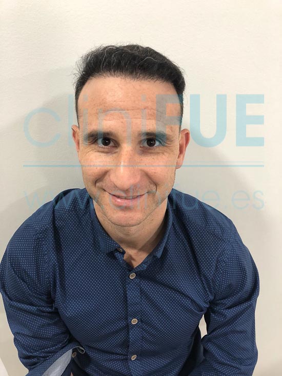 Antonio 39 años Murcia trasplante capilar turquia 6 meses