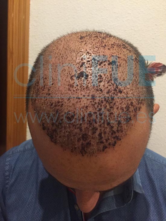 Antonio 39 años Murcia trasplante capilar turquia 7 dias