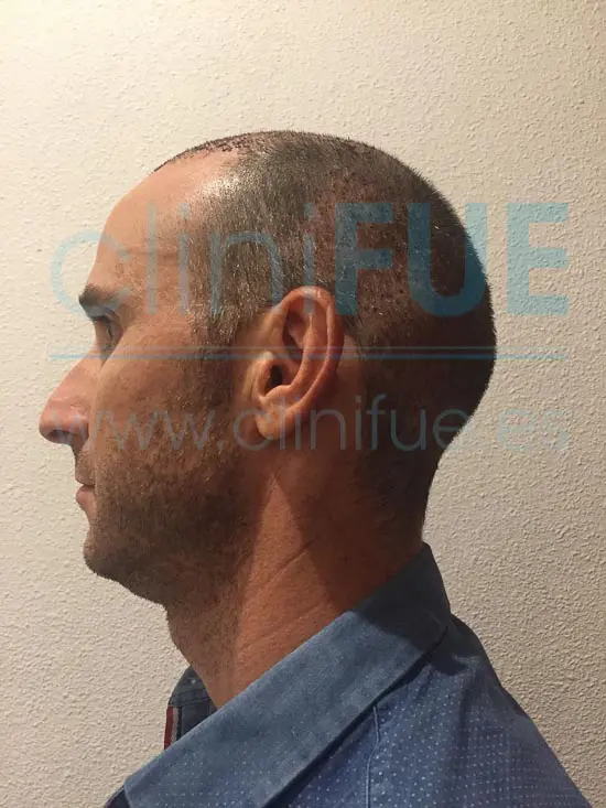 Antonio 39 años Murcia trasplante capilar turquia 7 dias