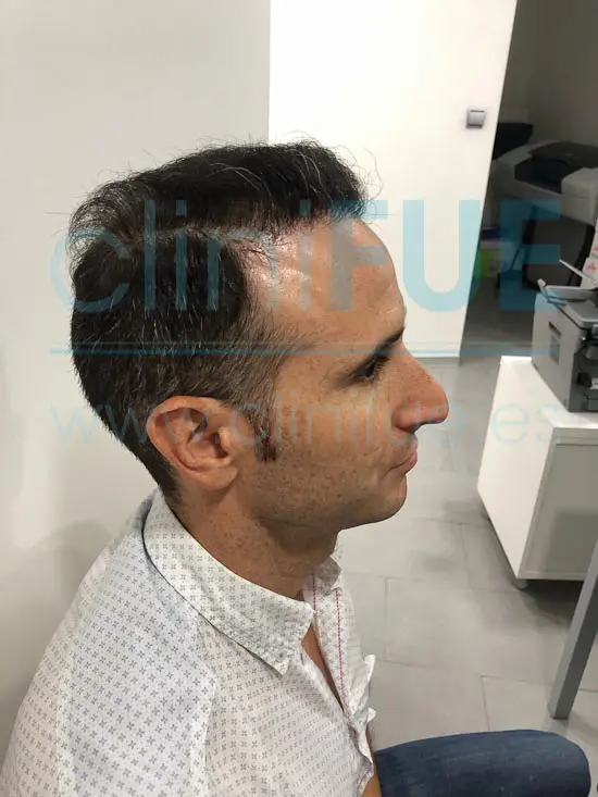 Antonio 39 años Murcia trasplante capilar turquia 9 meses