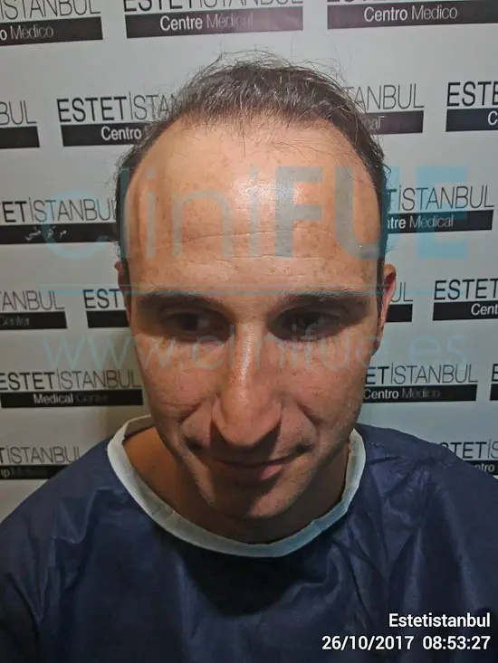 Antonio 39 años Murcia trasplante capilar turquia Antes