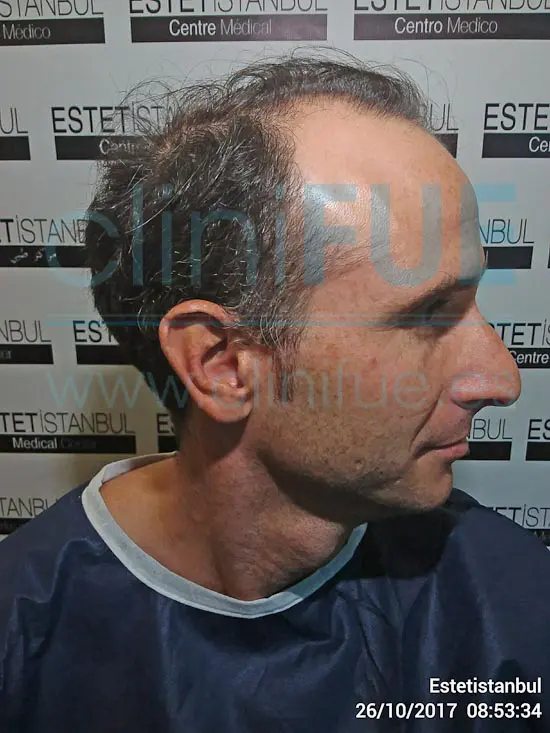 Antonio 39 años Murcia trasplante capilar turquia Antes