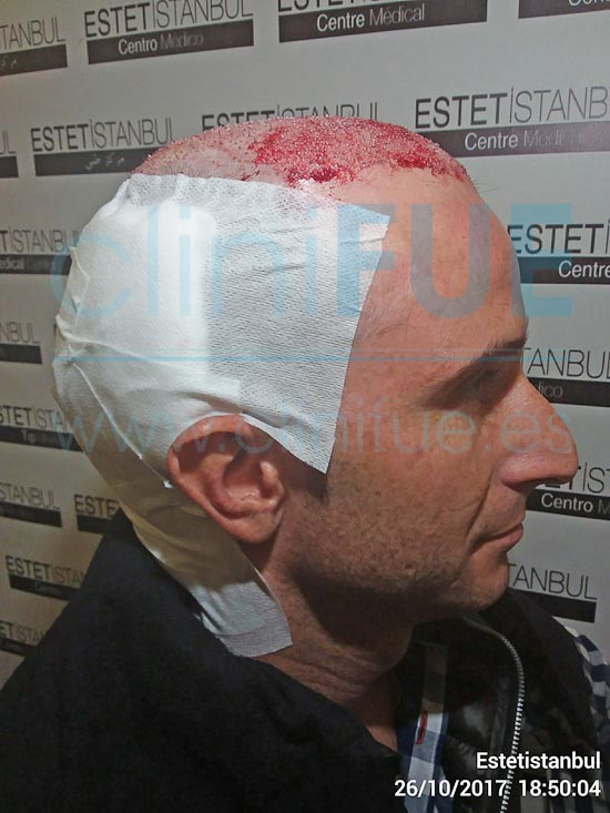 Antonio 39 años Murcia trasplante capilar turquia Dia Operacion